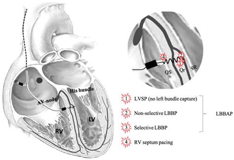 Jcm Free Full Text Comparing Ventricular Synchrony In Left Bundle
