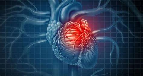Cuarta definición de infarto agudo de miocardio Consideraciones anestésicas perioperatorias
