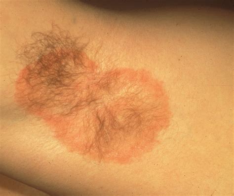 Armpit Ringworm Pictures