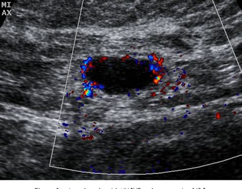 Figure 3 From Preoperative Staging Of Axillary Lymph Nodes In Breast