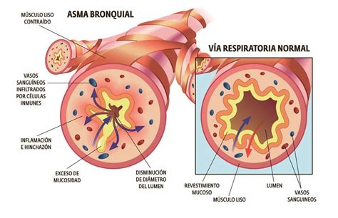 Diferencia Entre Bronquitis Y Asma Sintomas Causas Y Tratamiento