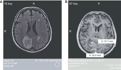 Magnetic Resonance Imaging Mri Of The Head Without Contrast Notes