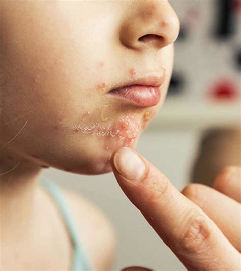 Hand Foot And Mouth Disease In Children Causes Symptoms And Home Care