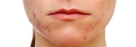 How To Treat Pih Acne Marks And Scars Healthsprings