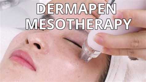 Dermapen Mesotherapy How Microneedling Treatment Is Done Nv6130