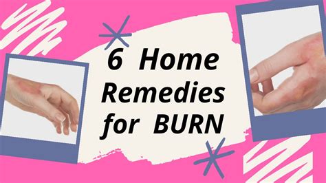 6 Home Remedies For Burn How To Treat Burns At Home How To Treat
