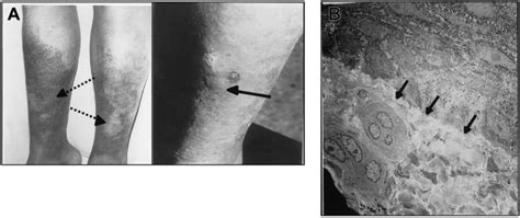 Pretibial Epidermolysis Bullosa In Pt2 A Photograph Showing Bullous