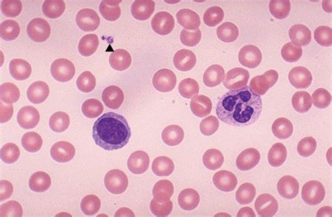Red Blood Cell Disorders Basicmedical Key