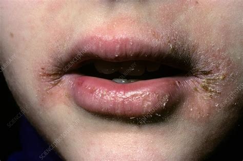 Skin Cracking Cheilitis At The Mouth Stock Image C0131058