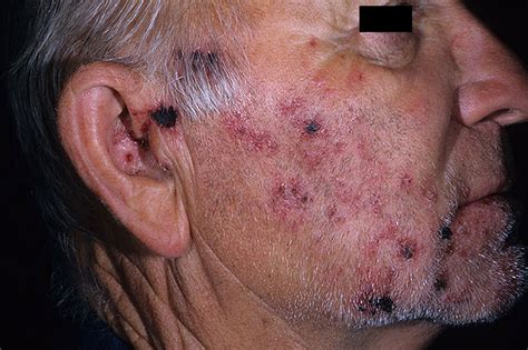 Improvement in the wong baker faces pain rating scale and neuropathic pain scale score was similar among treatment. Shingles Picture (Hardin MD Super Site Sample)