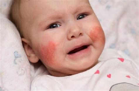 4 Cara Menghilangkan Bintik Merah Di Wajah Bayi