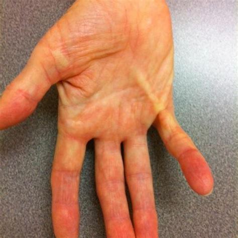 Dupuytrens Contracture Merivale Hand Clinic