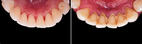 The Possible Of Causes Of Gum Disease London Specialist Dentists