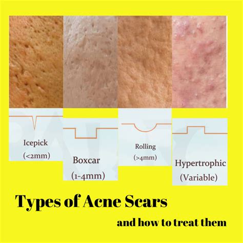 What Causes Acne Acne Scars And Treatments Dr Cindy S Medical