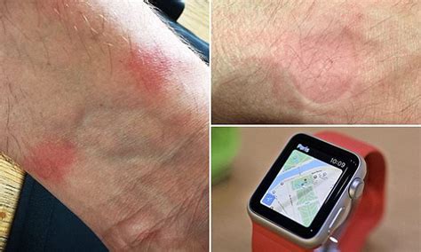 Apple Watch Wearers Share Photos Of Rashes Caused By Device On Twitter