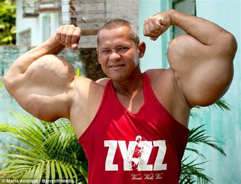 Deadly Bodybuilder Injects Self With Mixture Of Oil And Alcohol To Grow Fake Biceps Pictured