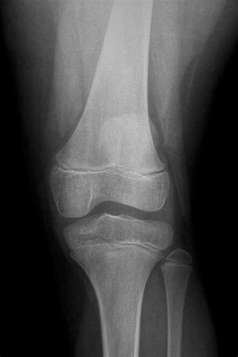 Child Knee X Ray Stock Photo Image Of Child Verticle 15528260