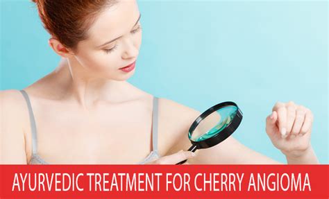 Ayurvedic Treatment For Cherry Angioma
