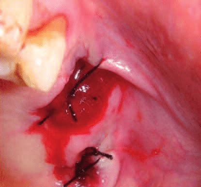 Les sutures peuvent également être utilisées comme moyen d hémostase