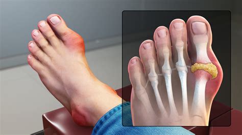 Gout In Big Toe How To Identify Causes And Treatment