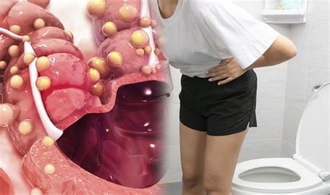 Bowel Cancer Symptoms Feeling A Lump In This Region Of The Body Could