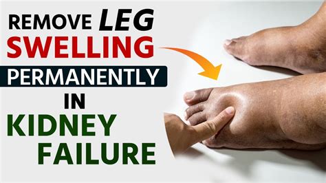 Remove Leg Swelling Permanently In Kidney Failure Youtube