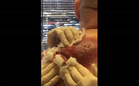 Ruptured Gross Abscess On The Back New Pimple Popping Videos