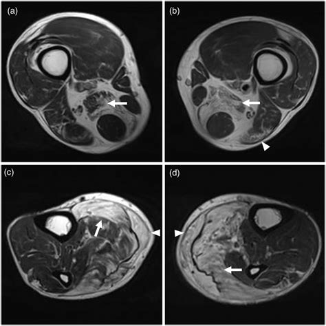 Magnetic Resonance Imaging Of Both Legs A B Axial T2 Weighted