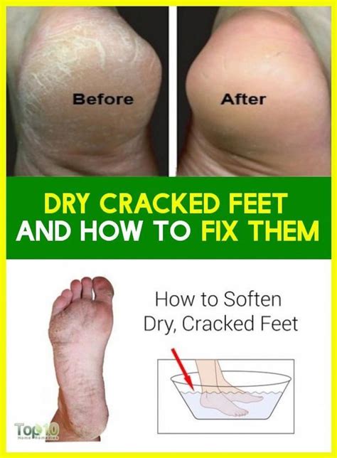 Dry Cracked Feet And How They Can Be Corrected