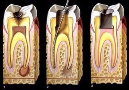Tratamentos Endodontia Odhos Odontologia Personalizada