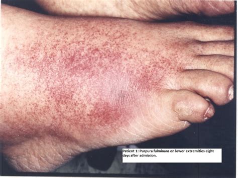 Pseudomonas Aeruginosa Infection
