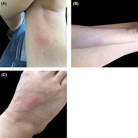 A‐c Multiple Erythematous Subcutaneous Nodules Of 3 To 4 Cm In