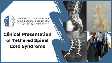 Clinical Presentation Of Tethered Spinal Cord Syndrome Youtube