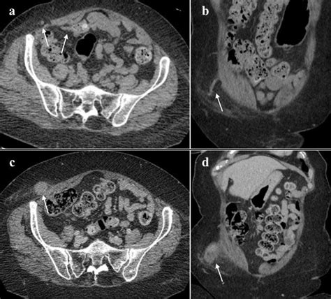 74 Year Old Female With Spigelian Hernia Herniated Appendix A And B