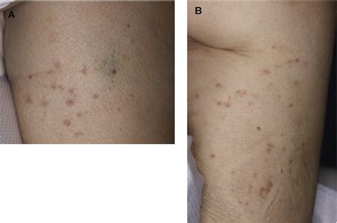 Non Blanching Erythematous Palpable Petechiae And Purpura On The Right