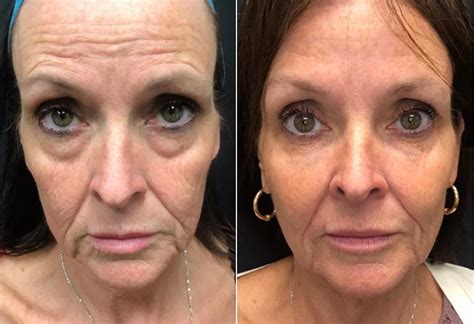 Juvederm Cheeks Before And After Photos
