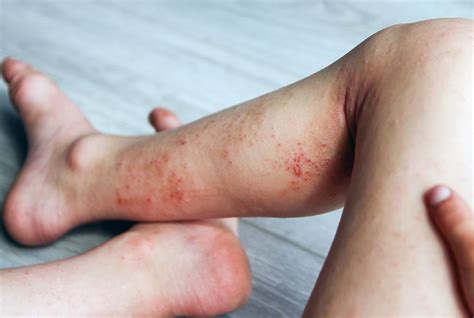 Dermatite Atopica Rimedi Innovativi Per La Tua Pelle