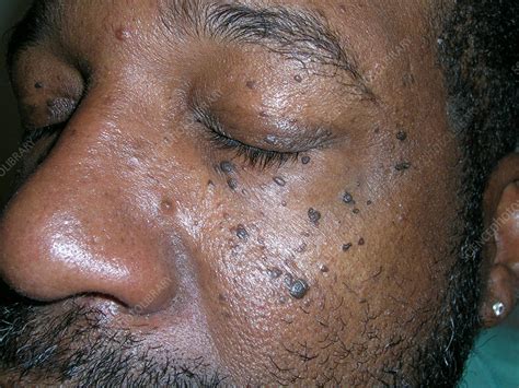 Dermatosis Papulosa Nigra Stock Image C0592784 Science Photo Library