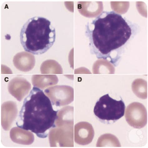 Discrete Vacuoles In Lymphocytes As A Subtle Clue To Mantle Cell Lymphoma