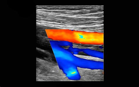 Vascular Ultrasound Of Legs