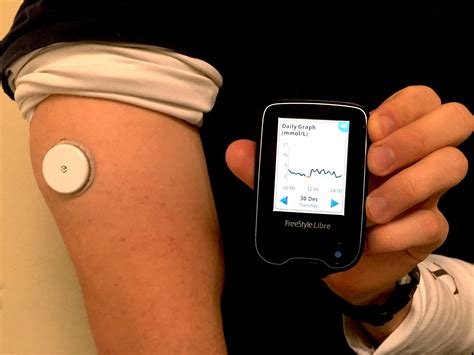 Abbotts Freestyle Libre Transforming Glucose Monitoring Through