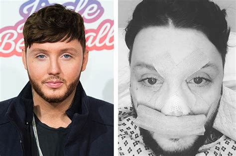 james arthur undergoes nose job after one too many scuffles daily star