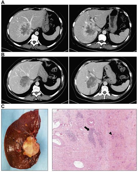 Liver Resection And Transplantation For Intrahepatic Cholangiocarcinoma