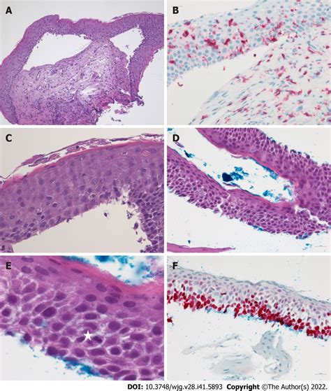 Esophageal Epidermoid Metaplasia In Esophageal Lichen Planus A C