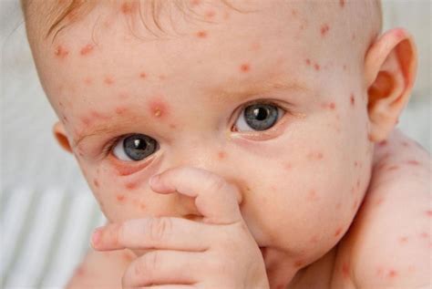 Mengenal Lebih Dekat Tentang Penyakit Cacar Small Pox Bio Safety