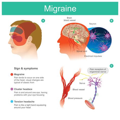 What Are The Underlying Causes Of Chronic Migraines Truly Heal