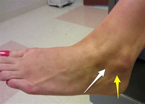 Ankle Sprains Dr David Geier Sports Medicine Simplified
