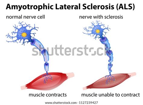 Amyotrophic Lateral Sclerosis Concept Illustration Stock Vector