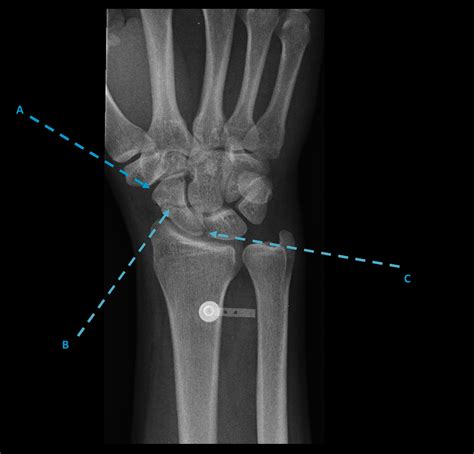 A Young Man With Wrist Pain The Bmj
