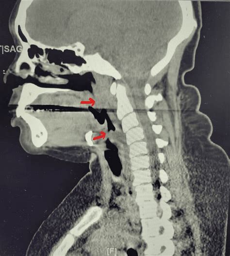 Effacement Of The Airway Originating At The Level Of The Hyoid Bone